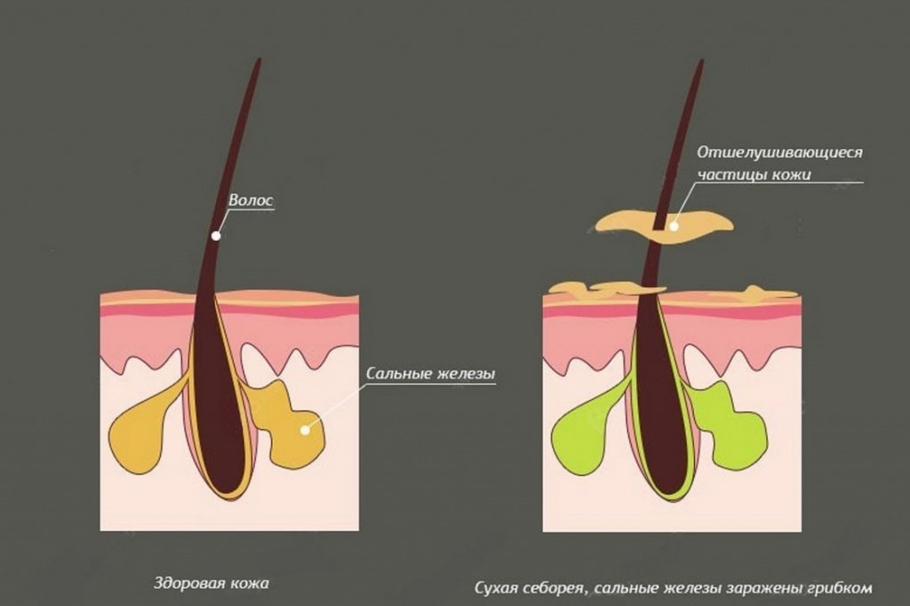 Почему появляется себорейная алопеция
