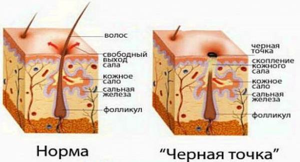 Как избавиться от черных точек