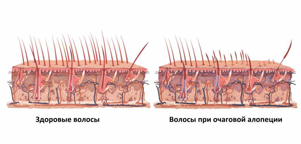 Алопеция волос