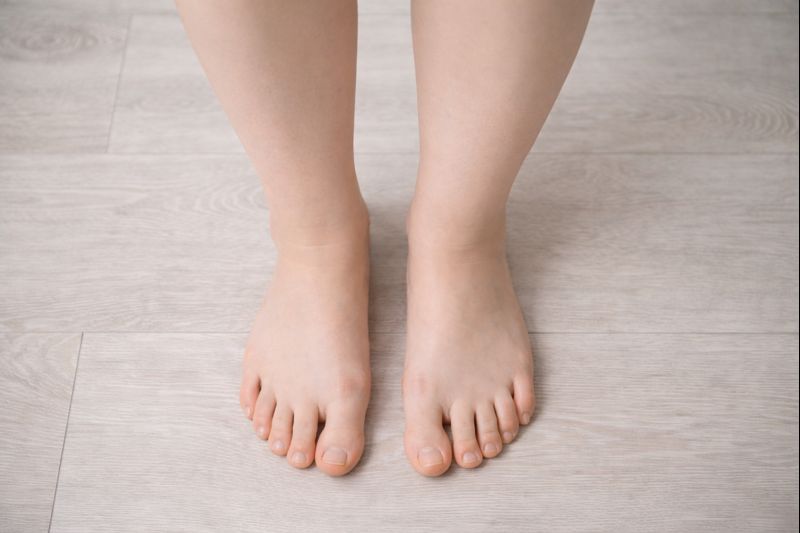 Как убрать отеки  сног